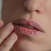 О каких болезнях могут сигнализировать сухие губы?