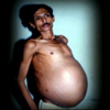 Индийский мужчина 36 лет носил своего близнеца в животе