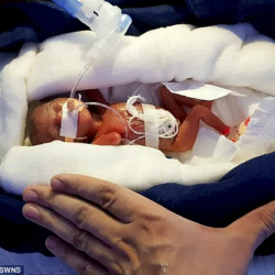 СҮРӨТ- Шокаладдын көлөмүндөй болгон наристе дүйнөгө келди