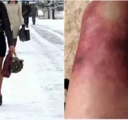 Суукта капрон колготки кийген бийкечтин бутун үшүк алып