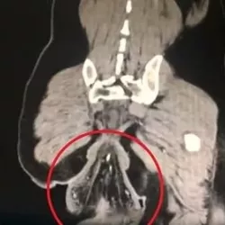 Китаец досиделся на унитазе до потери кишок