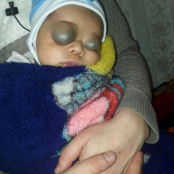 СҮРӨТ: Эки көзүнүн ордуна кара шишик толуп калган наристеге жардам керек