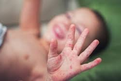 Жугуштуу оорулар кескин өстү