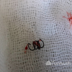 Ошко оор абалда жеткирилген баланын өпкөсүнөн пружина алып чыгышты