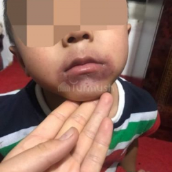 Бакчадан оозу көгөрүп кайткан баланын ата-энеси кошумча экспертиза талап кылды