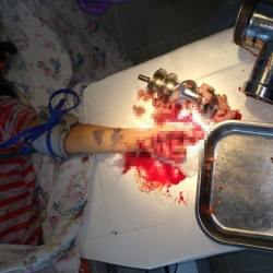  Эт туурагычка чайналган 5 жаштагы кыздын колун врачтар микроскоптун жардамы менен чогултту