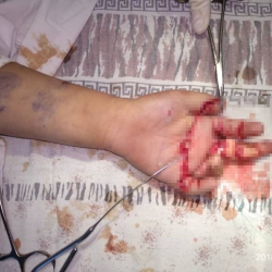 Колун эт туурагычка салып жиберген кыздын манжаларынын тырмак бөлүгүнө жан кирбей калышы мүмкүн