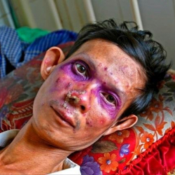 Медицина тарыхында ВИЧ-инфекциялуу экинчи адам бул оорудан айыгышы мүмкүн