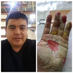 ВИДЕО - Тынар Курбаналиевдин колу күйүп ооруканага түштү, тили жайында...