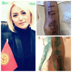 Аттан кулаган жаачы кыз коомчулукка кайрылды