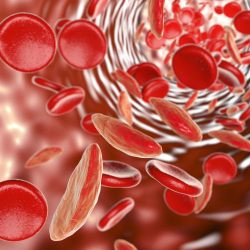 Кыргызстанда ар бир экинчи бала анемиядан жабыркайт