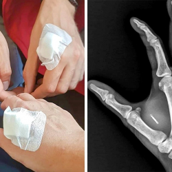 СҮРӨТ - Швецияда теринин астына чип жайгаштыруу күч алды