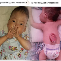 Кичинекей Айшанын операциясына жардам керек