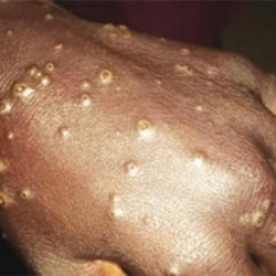 СҮРӨТ - Африкада адамдарга белгисиз оору жугууда