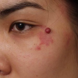 Денедеги кызыл меңдер кандай көйгөйдү билдириши мүмкүн?