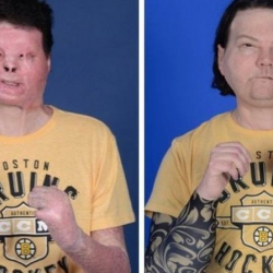 Дүйнөдө биринчи жолу: 23 жаштагы жигиттин бети, 2 колунун манжалары алмаштырылды