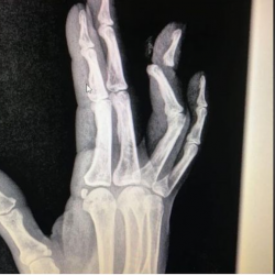 Бишкекте кыз үйлөнүүдөн баш тарткан жигитинин манжасын сындырып салды