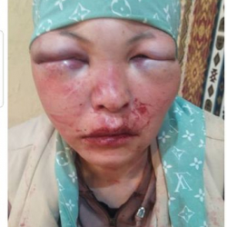 ФОТО - Женщину с инвалидностью жестоко избил муж. Почему мужчину отпустили?