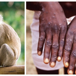 Маймыл чечек илдети дүйнөнүн 12 өлкөсүндө аныкталды