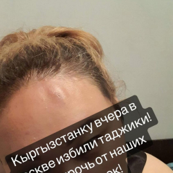 ФОТО - Ассоль Молдокматова: Вчера вечером в Москве избили  кыргызстанку. Это подло, мерзко и не по-людски!