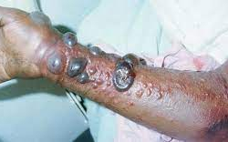 Жаңы марбург вирусу Африкада тарай баштады