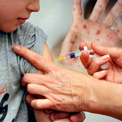 В Кыргызстане отмечается рост заболеваемости корью и краснухой