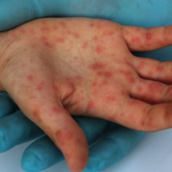 Өлкөдө кызамыкка чалдыккандардын саны көбөйүүдө