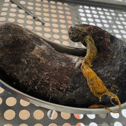 Бишкекте дарыгерлер 18 жаштагы кыздын ашказанынан 4 кг чач алып чыкты