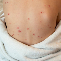 Кыргызстанда жыл башынан бери кызамык оорусунун 536 учуру аныкталды