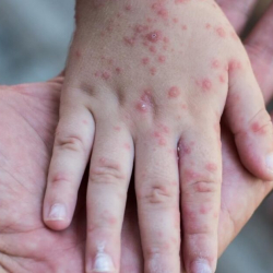 Өлкөдө эки айда сегиз бала кызамыктан көз жумду